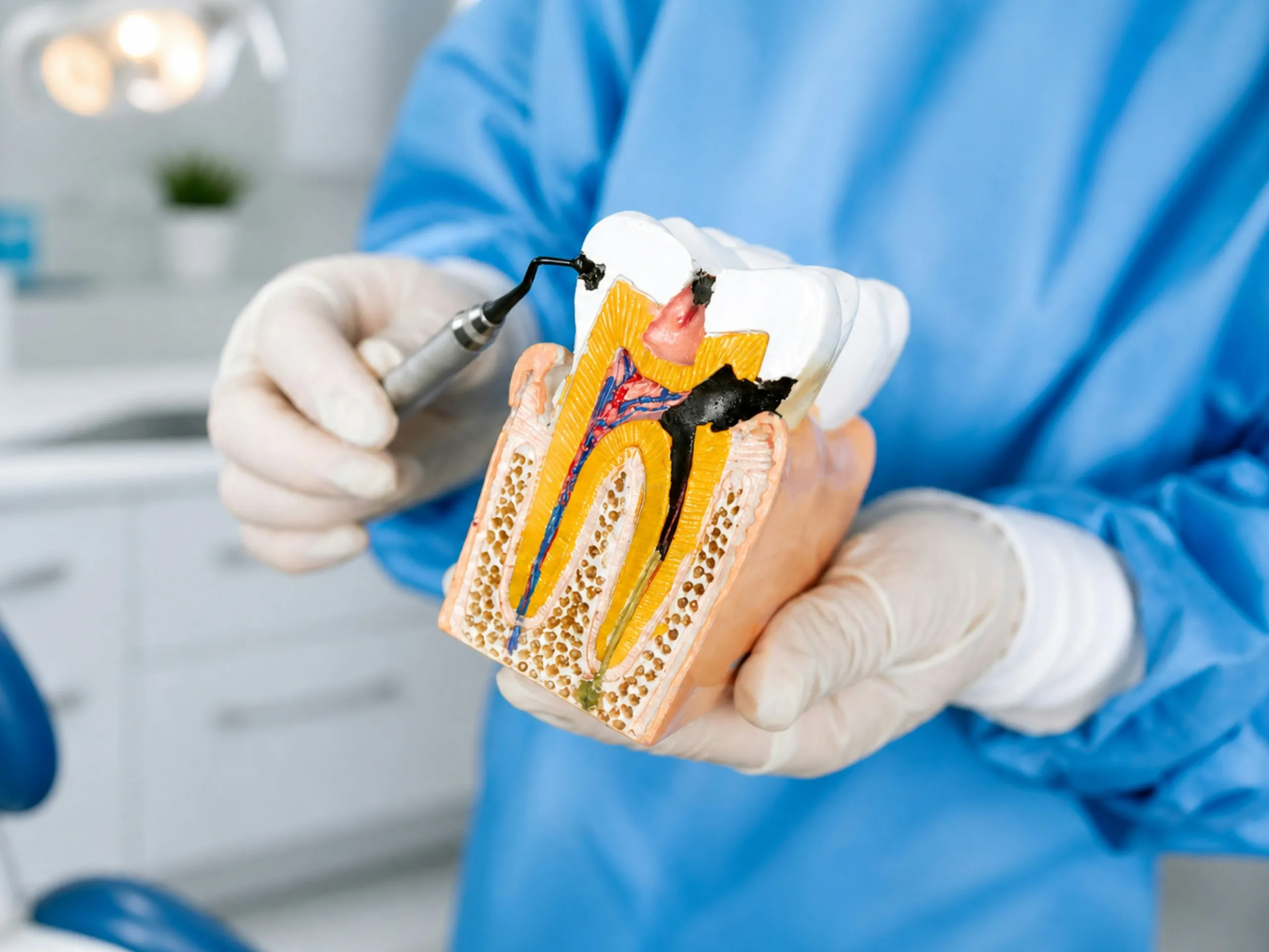 Dentysta prezentuje model przekroju zęba z ubytkiem próchnicowym